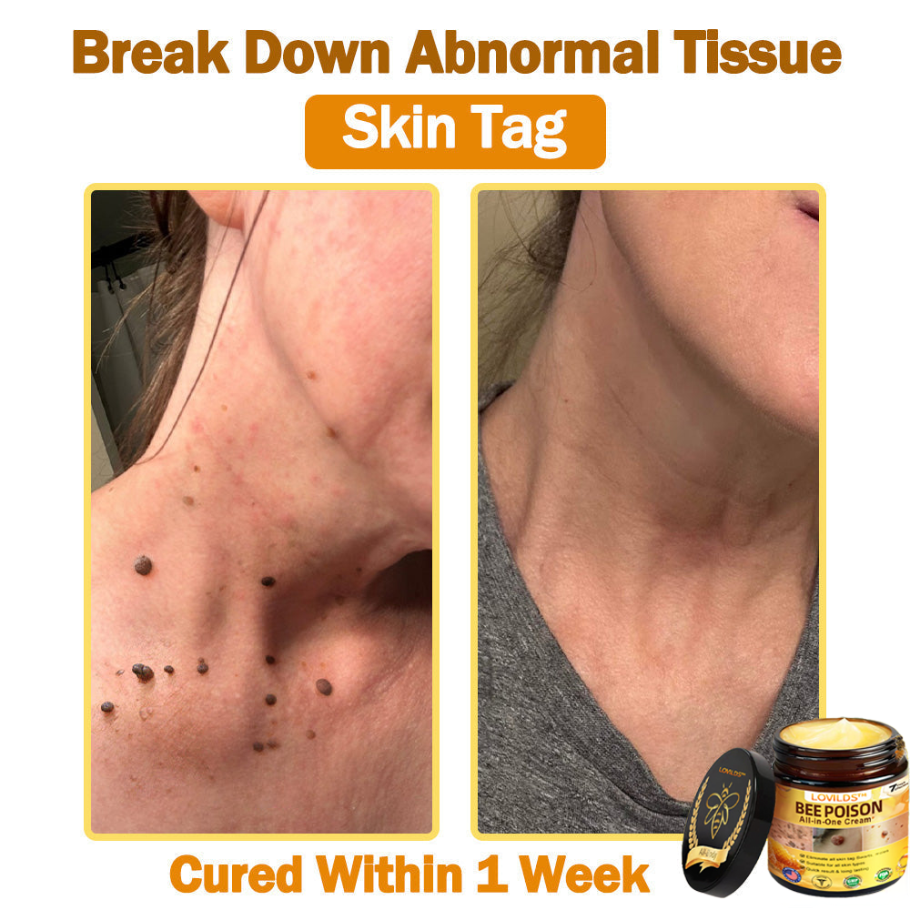 [𝐎𝐟𝐟𝐢𝐜𝐢𝐚𝐥 𝐁𝐫𝐚𝐧𝐝 𝐒𝐭𝐨𝐫𝐞] 🐝 LOVILDS™ 𝐁𝐞𝐞 𝐕𝐞𝐧𝐨𝐦 𝐀𝐥𝐥-𝐢𝐧-𝐎𝐧𝐞 𝐂𝐫𝐞𝐚𝐦 (👩‍⚕️ 𝐀𝐦𝐞𝐫𝐢𝐜𝐚𝐧 𝐀𝐜𝐚𝐝𝐞𝐦𝐲 𝐨𝐟 𝐃𝐞𝐫𝐦𝐚𝐭𝐨𝐥𝐨𝐠𝐲 𝟐𝟎𝟐𝟓 𝐒𝐩𝐞𝐜𝐢𝐚𝐥𝐥𝐲 𝐑𝐞𝐜𝐨𝐦𝐦𝐞𝐧𝐝𝐞𝐝 𝐏𝐫𝐨𝐝𝐮𝐜𝐭)