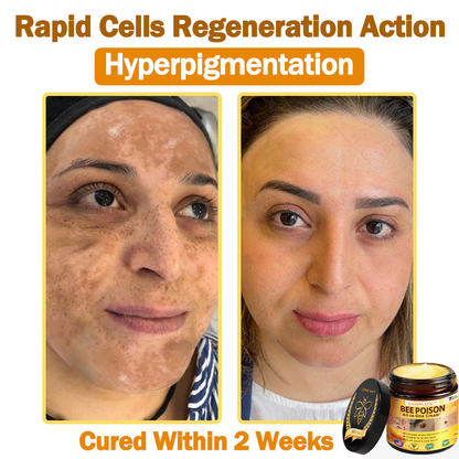 [𝐎𝐟𝐟𝐢𝐜𝐢𝐚𝐥 𝐁𝐫𝐚𝐧𝐝 𝐒𝐭𝐨𝐫𝐞] 🐝 LOVILDS™ 𝐁𝐞𝐞 𝐕𝐞𝐧𝐨𝐦 𝐀𝐥𝐥-𝐢𝐧-𝐎𝐧𝐞 𝐂𝐫𝐞𝐚𝐦 (👩‍⚕️ 𝐀𝐦𝐞𝐫𝐢𝐜𝐚𝐧 𝐀𝐜𝐚𝐝𝐞𝐦𝐲 𝐨𝐟 𝐃𝐞𝐫𝐦𝐚𝐭𝐨𝐥𝐨𝐠𝐲 𝟐𝟎𝟐𝟓 𝐒𝐩𝐞𝐜𝐢𝐚𝐥𝐥𝐲 𝐑𝐞𝐜𝐨𝐦𝐦𝐞𝐧𝐝𝐞𝐝 𝐏𝐫𝐨𝐝𝐮𝐜𝐭)