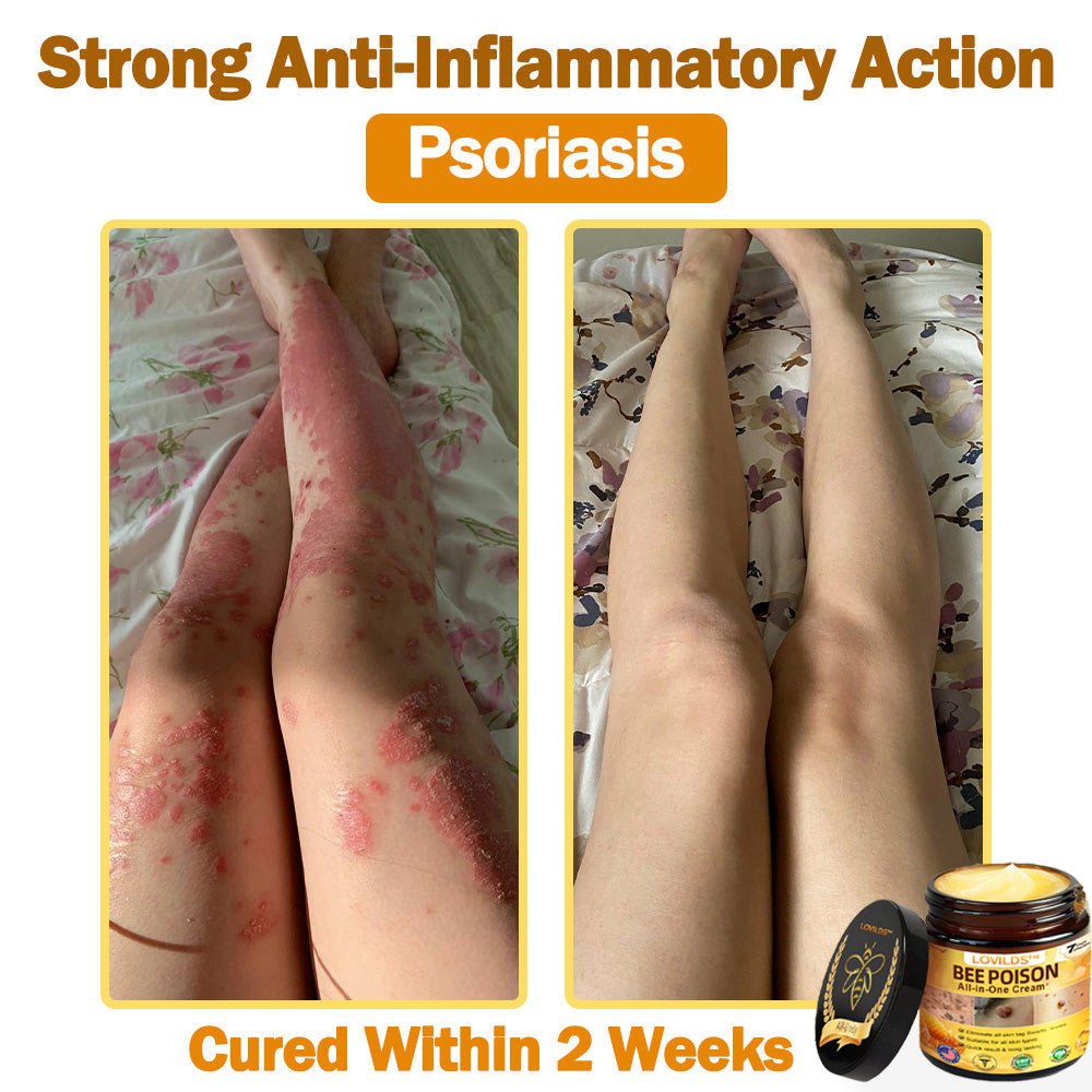 [𝐎𝐟𝐟𝐢𝐜𝐢𝐚𝐥 𝐁𝐫𝐚𝐧𝐝 𝐒𝐭𝐨𝐫𝐞] 🐝 LOVILDS™ 𝐁𝐞𝐞 𝐕𝐞𝐧𝐨𝐦 𝐀𝐥𝐥-𝐢𝐧-𝐎𝐧𝐞 𝐂𝐫𝐞𝐚𝐦 (👩‍⚕️ 𝐀𝐦𝐞𝐫𝐢𝐜𝐚𝐧 𝐀𝐜𝐚𝐝𝐞𝐦𝐲 𝐨𝐟 𝐃𝐞𝐫𝐦𝐚𝐭𝐨𝐥𝐨𝐠𝐲 𝟐𝟎𝟐𝟓 𝐒𝐩𝐞𝐜𝐢𝐚𝐥𝐥𝐲 𝐑𝐞𝐜𝐨𝐦𝐦𝐞𝐧𝐝𝐞𝐝 𝐏𝐫𝐨𝐝𝐮𝐜𝐭)