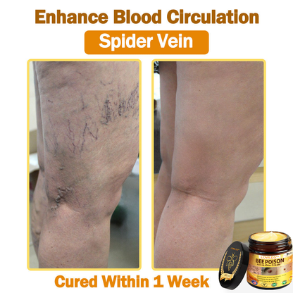 [𝐎𝐟𝐟𝐢𝐜𝐢𝐚𝐥 𝐁𝐫𝐚𝐧𝐝 𝐒𝐭𝐨𝐫𝐞] 🐝 LOVILDS™ 𝐁𝐞𝐞 𝐕𝐞𝐧𝐨𝐦 𝐀𝐥𝐥-𝐢𝐧-𝐎𝐧𝐞 𝐂𝐫𝐞𝐚𝐦 (👩‍⚕️ 𝐀𝐦𝐞𝐫𝐢𝐜𝐚𝐧 𝐀𝐜𝐚𝐝𝐞𝐦𝐲 𝐨𝐟 𝐃𝐞𝐫𝐦𝐚𝐭𝐨𝐥𝐨𝐠𝐲 𝟐𝟎𝟐𝟓 𝐒𝐩𝐞𝐜𝐢𝐚𝐥𝐥𝐲 𝐑𝐞𝐜𝐨𝐦𝐦𝐞𝐧𝐝𝐞𝐝 𝐏𝐫𝐨𝐝𝐮𝐜𝐭)