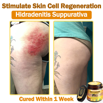 [𝐎𝐟𝐟𝐢𝐜𝐢𝐚𝐥 𝐁𝐫𝐚𝐧𝐝 𝐒𝐭𝐨𝐫𝐞] 🐝 LOVILDS™ 𝐁𝐞𝐞 𝐕𝐞𝐧𝐨𝐦 𝐀𝐥𝐥-𝐢𝐧-𝐎𝐧𝐞 𝐂𝐫𝐞𝐚𝐦 (👩‍⚕️ 𝐀𝐦𝐞𝐫𝐢𝐜𝐚𝐧 𝐀𝐜𝐚𝐝𝐞𝐦𝐲 𝐨𝐟 𝐃𝐞𝐫𝐦𝐚𝐭𝐨𝐥𝐨𝐠𝐲 𝟐𝟎𝟐𝟓 𝐒𝐩𝐞𝐜𝐢𝐚𝐥𝐥𝐲 𝐑𝐞𝐜𝐨𝐦𝐦𝐞𝐧𝐝𝐞𝐝 𝐏𝐫𝐨𝐝𝐮𝐜𝐭)